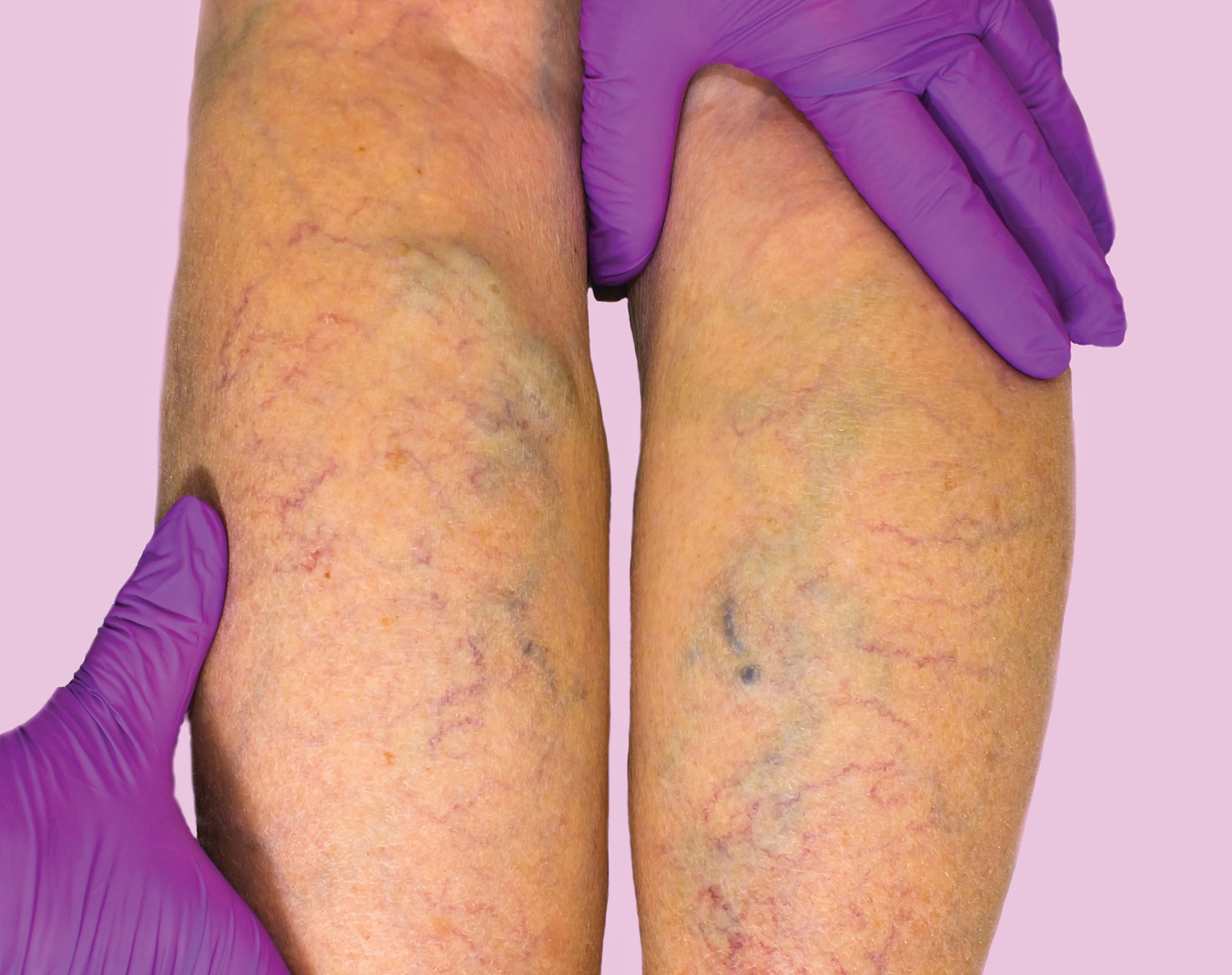 Vascullar Surgery
